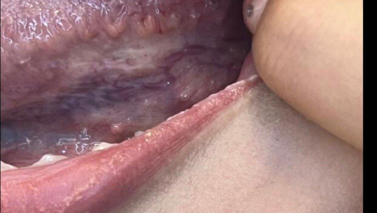 我口腔hpv查了四次了都是阴性,我的是口腔尖锐湿疣吗?