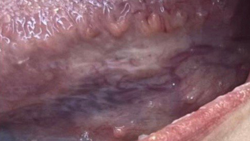 我口腔hpv查了四次了都是阴性,我的是口腔尖锐湿疣吗?