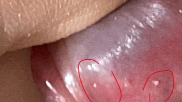 我今天洗澡前发现y茎左右两侧冠状沟分别有白色的小凸起