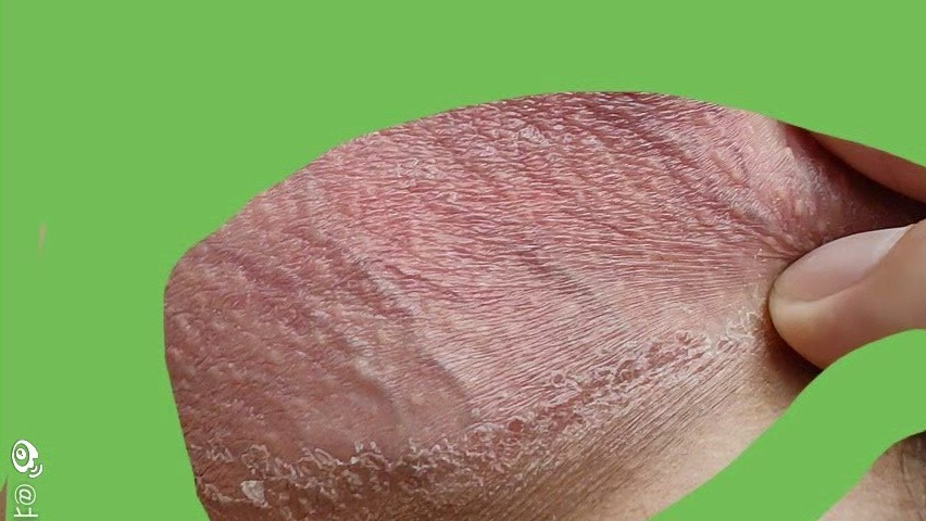 阴囊下外部皮肤发红干蜕皮