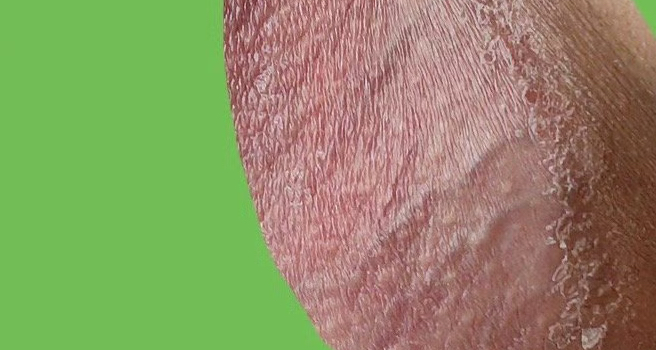 阴囊下外部皮肤发红干蜕皮