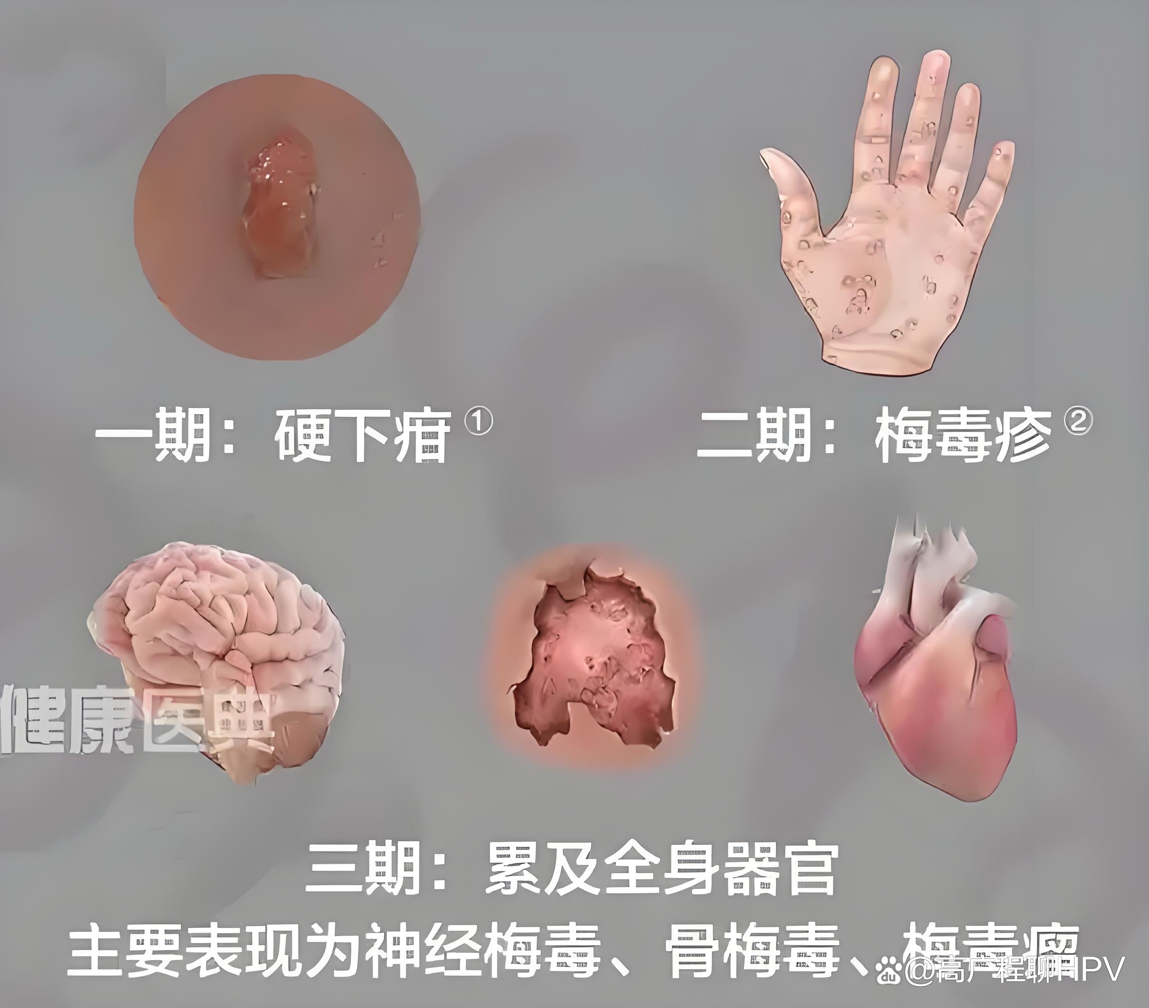 肠胃镜前检查出来的,rpr1:4,tp