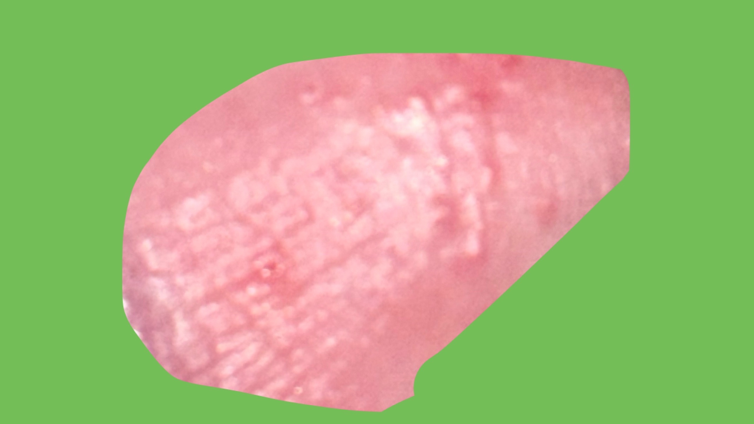 就是洗澡的时候发现龟头上面长了很多这种痘痘