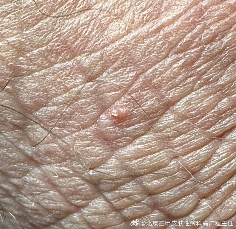 阴囊有一个增生物,是不是发生病变了?