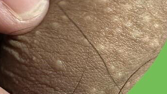 下面痒热,有这些小疙瘩,我怎么治疗?