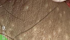 下面痒热,有这些小疙瘩,我怎么治疗?