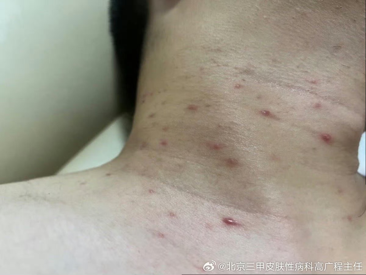 脖子里面长了一些红疙瘩,这个是不是梅毒之类的?