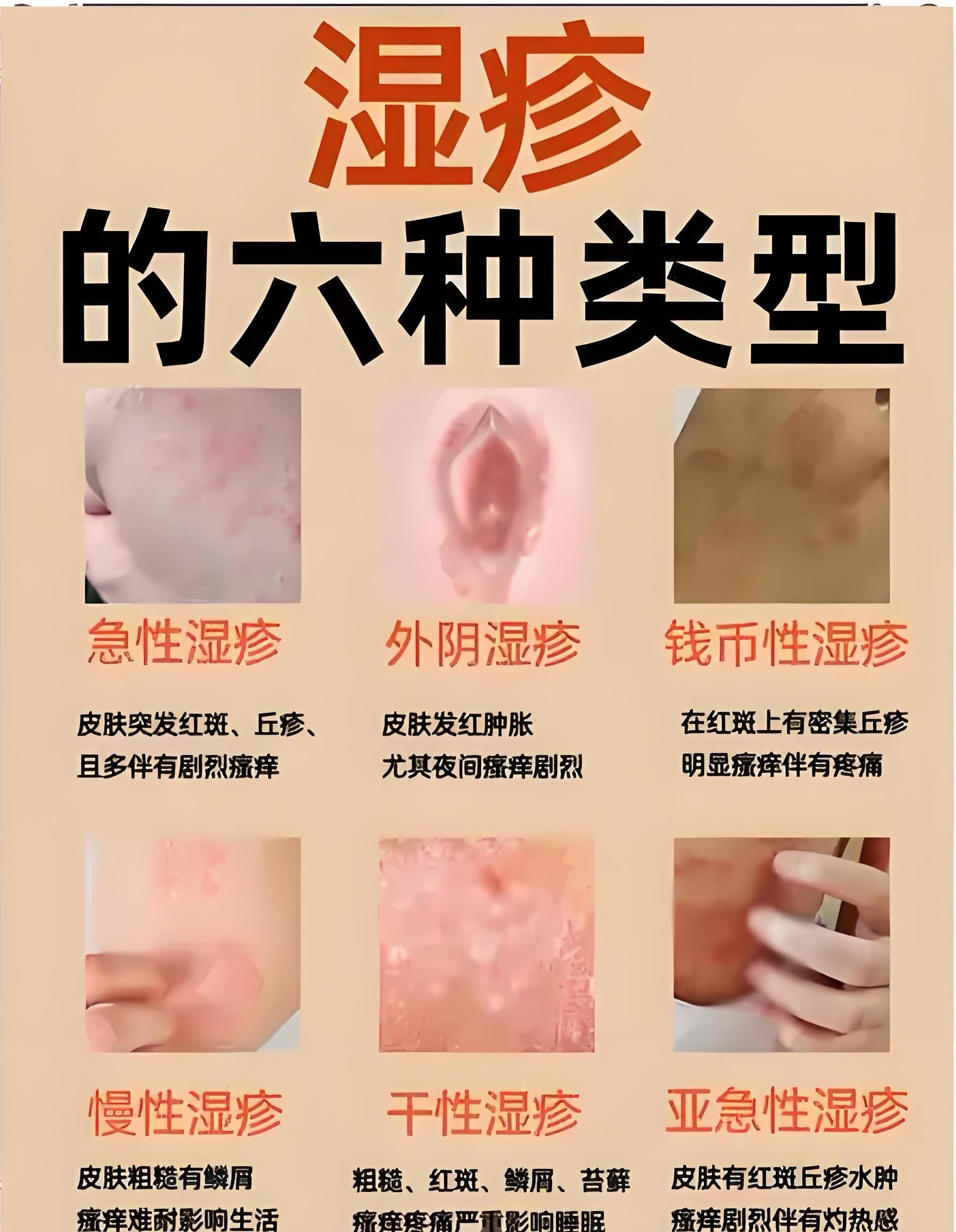 湿疹可以怎么样使用激素药膏治疗?