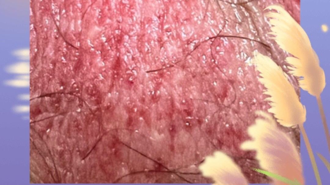 阴囊皮肤大面积泛红瘙痒两日