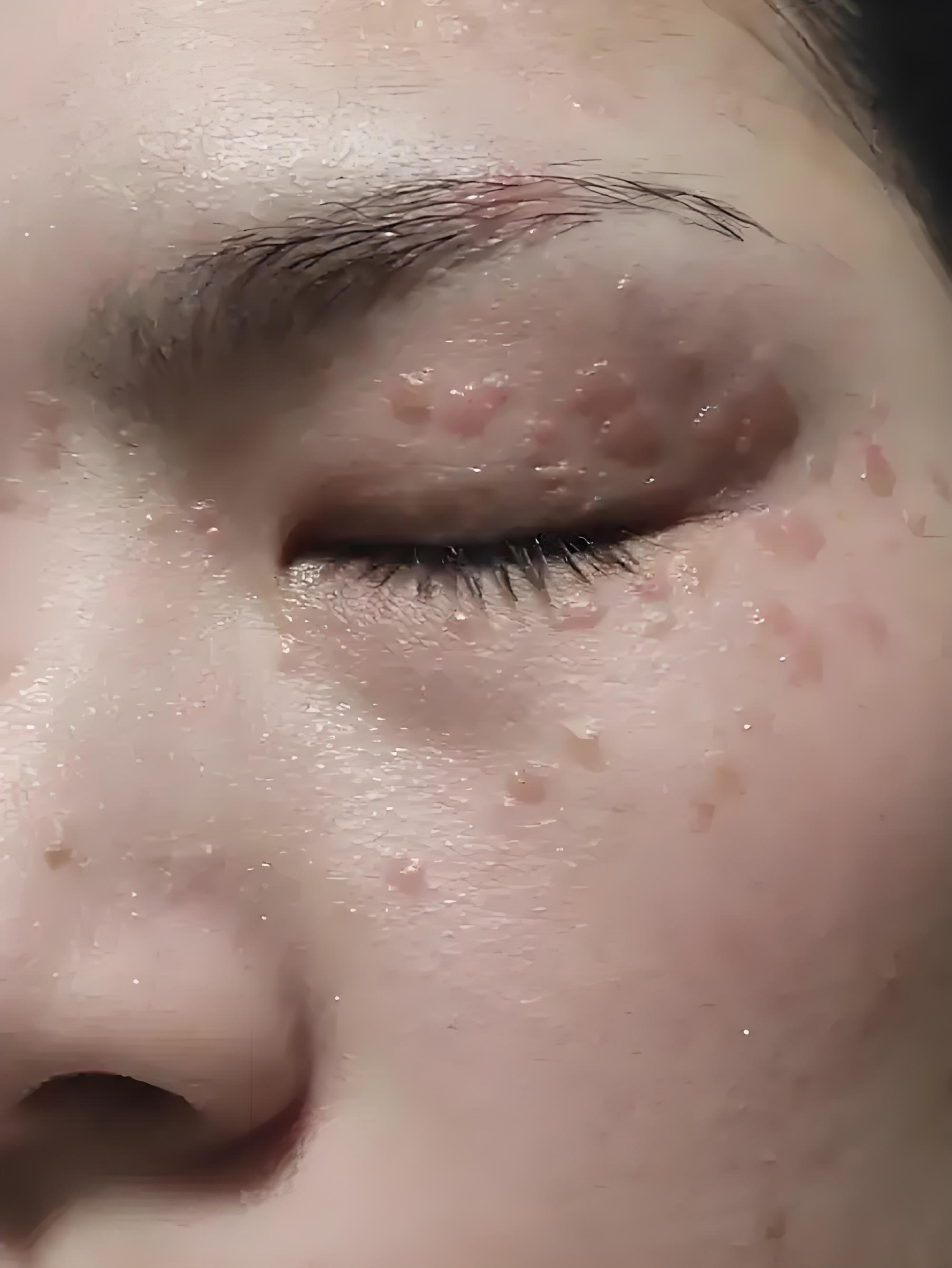 这两年脸上扁平疣越来越多,是不是身体hpv病毒也越来越多?