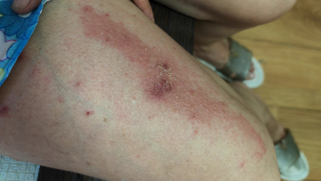 湿疹一直不好,全身都有,痒,大腿上成片