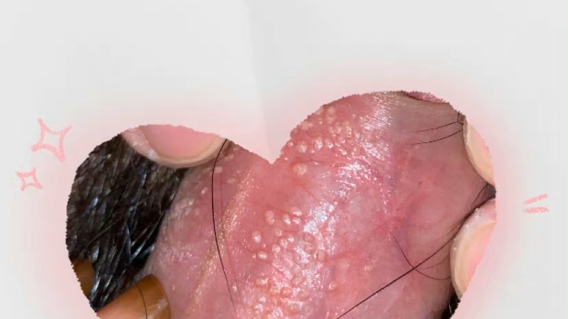 是否是阴茎珍珠疹,还是别的什么疾病?