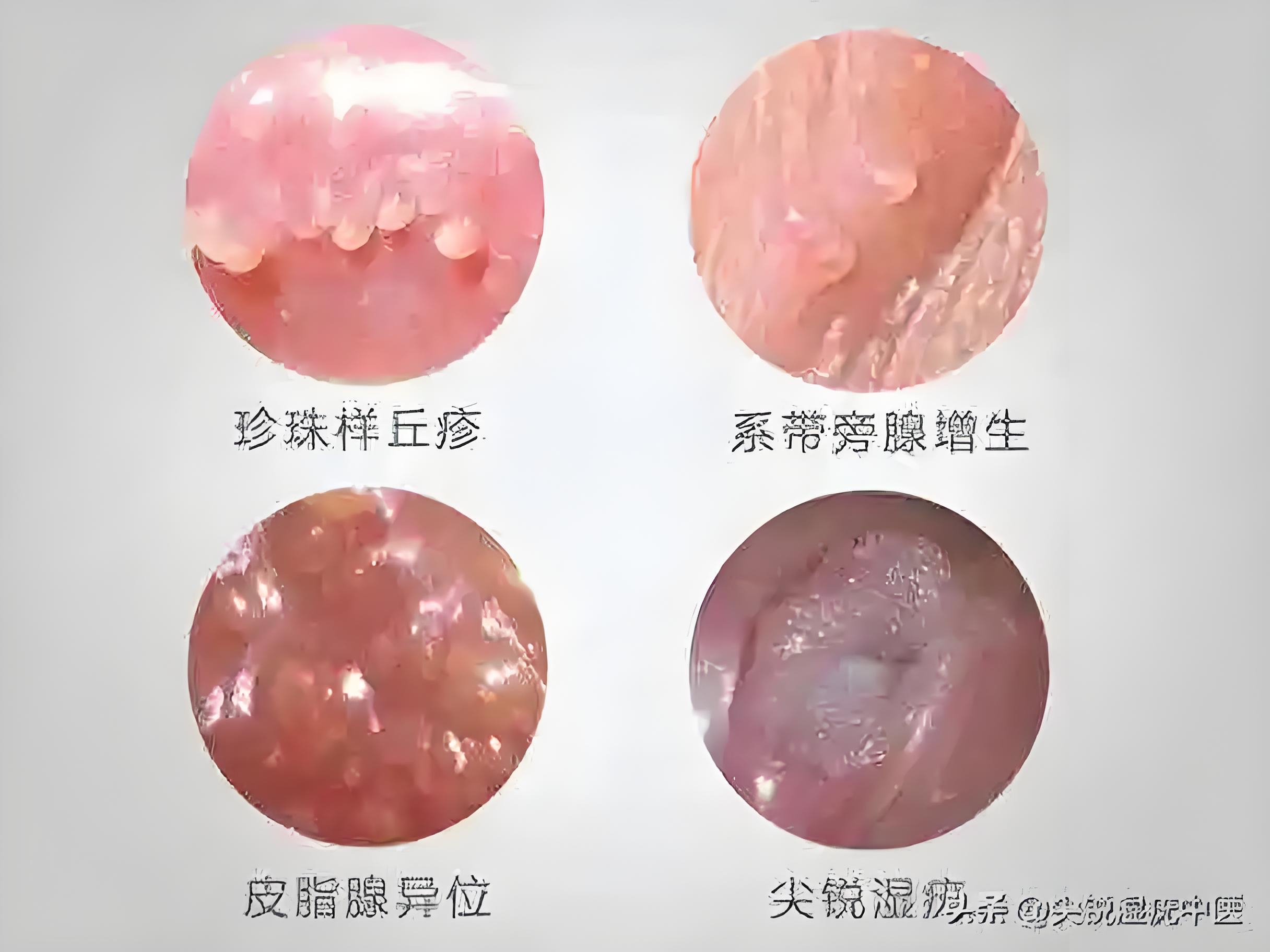 长在生殖器上的"小疙瘩"都是尖锐湿疣吗?