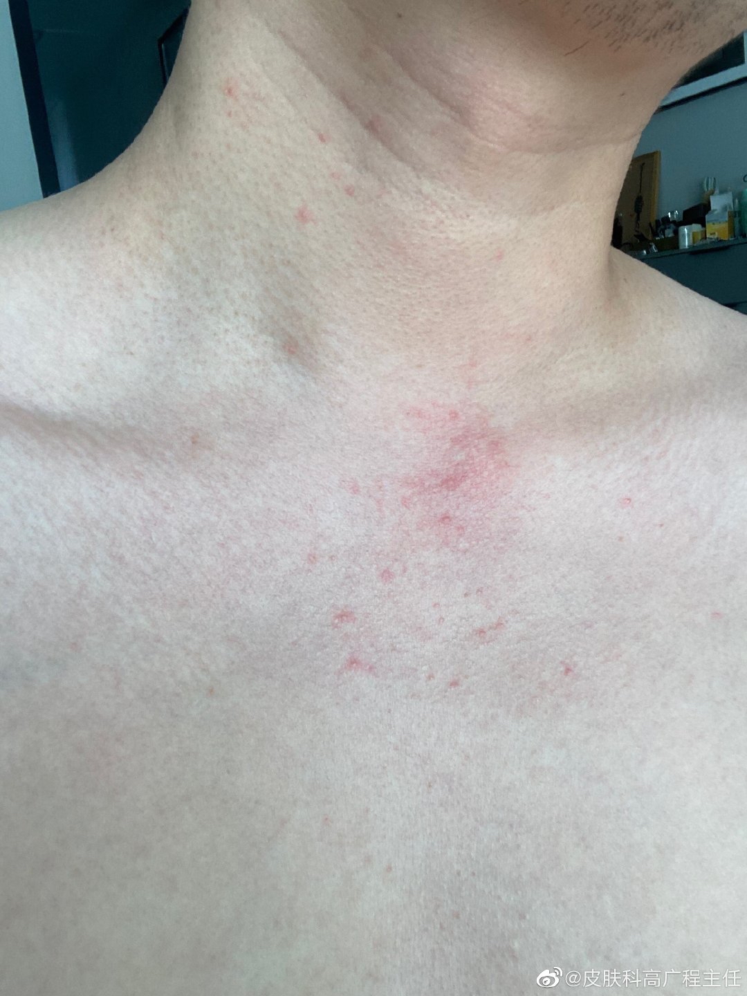 这两天脖子这块长了很多小红痘,和梅毒hiv有关系嘛?