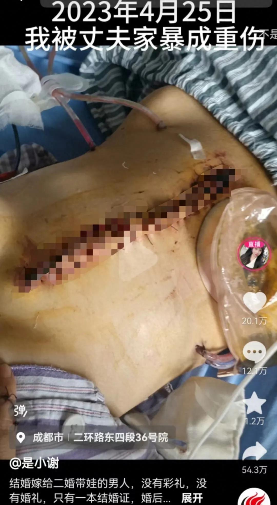 而前夫把她打成终生挂粪袋却