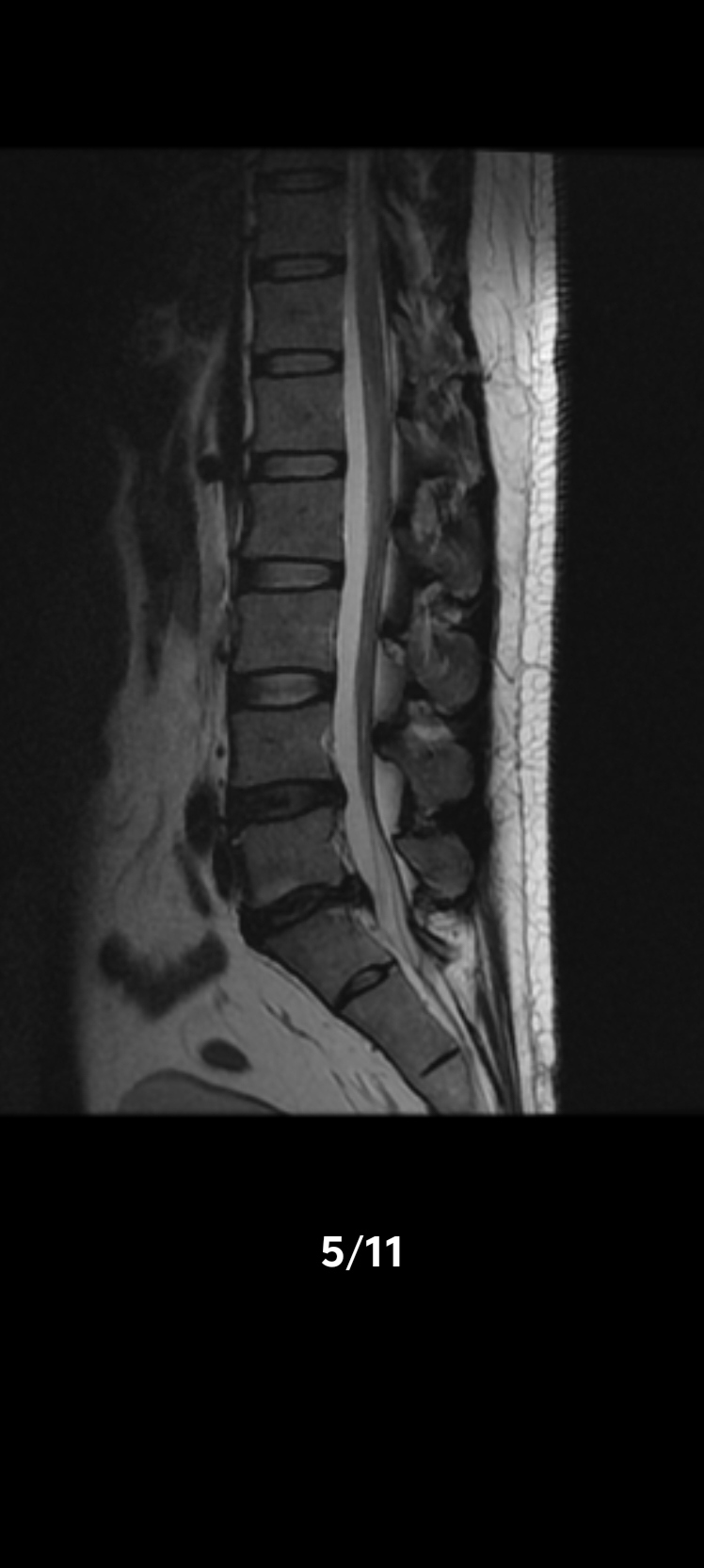 这辈子哪方面表现也不突出,唯独腰椎间盘突出