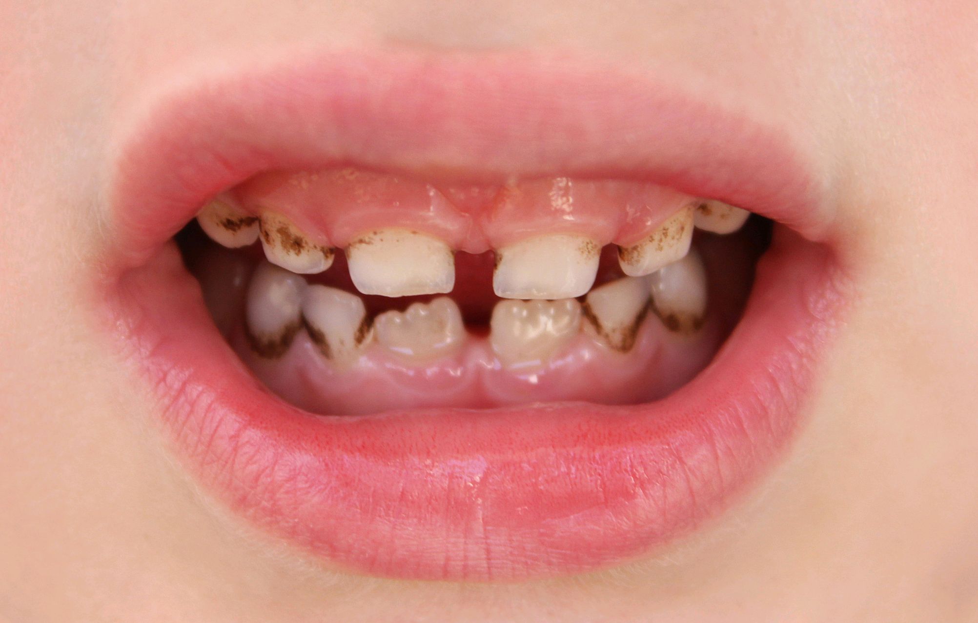 孩子牙齿变黑,原因复杂多样.首先,龋齿是