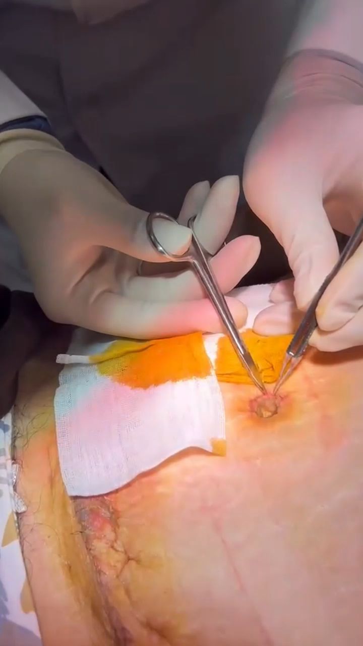 腹壁整形术后拆线,离恢复越来越近了