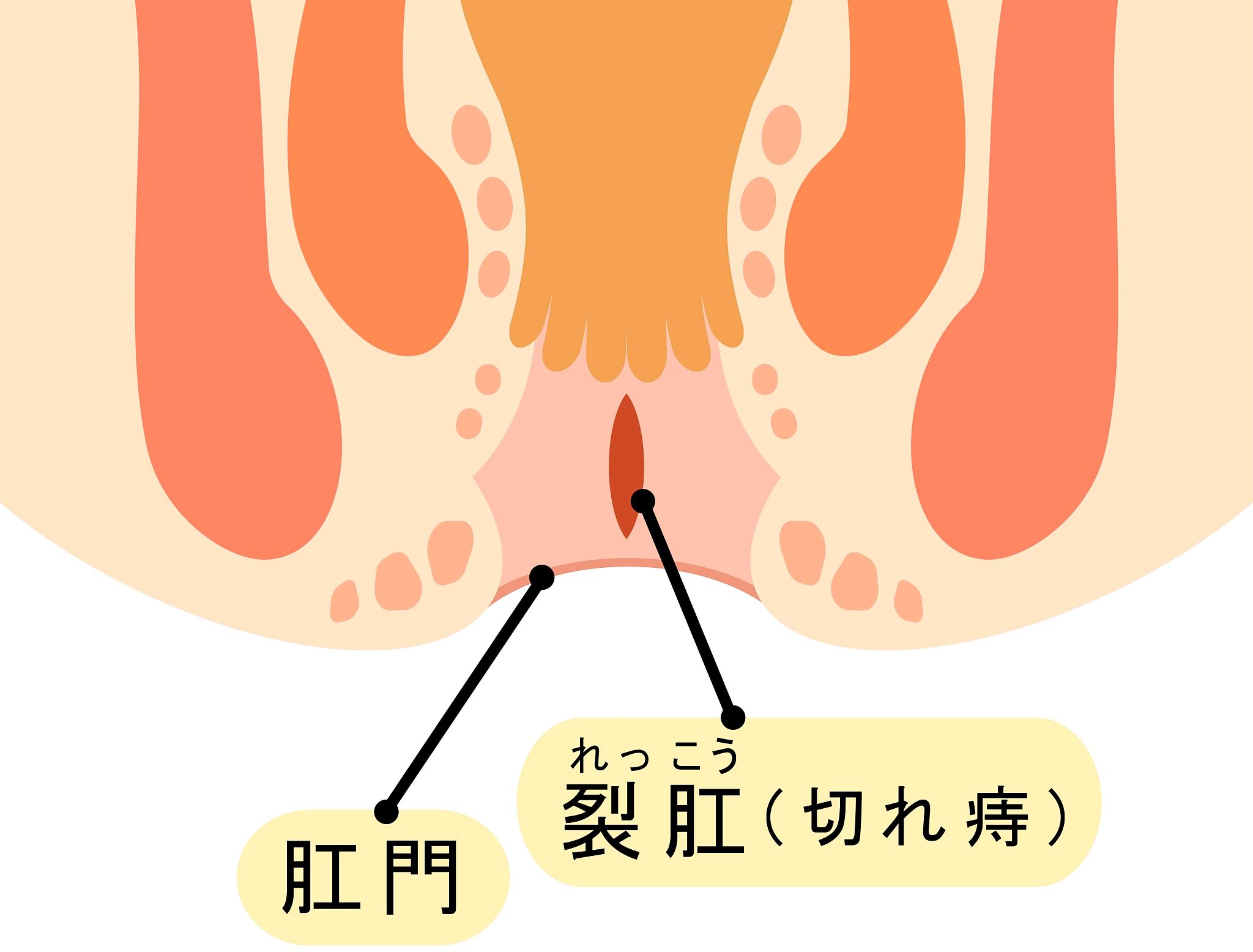 痔疮疼痛出血怎么办?一文掌握科学应对方案