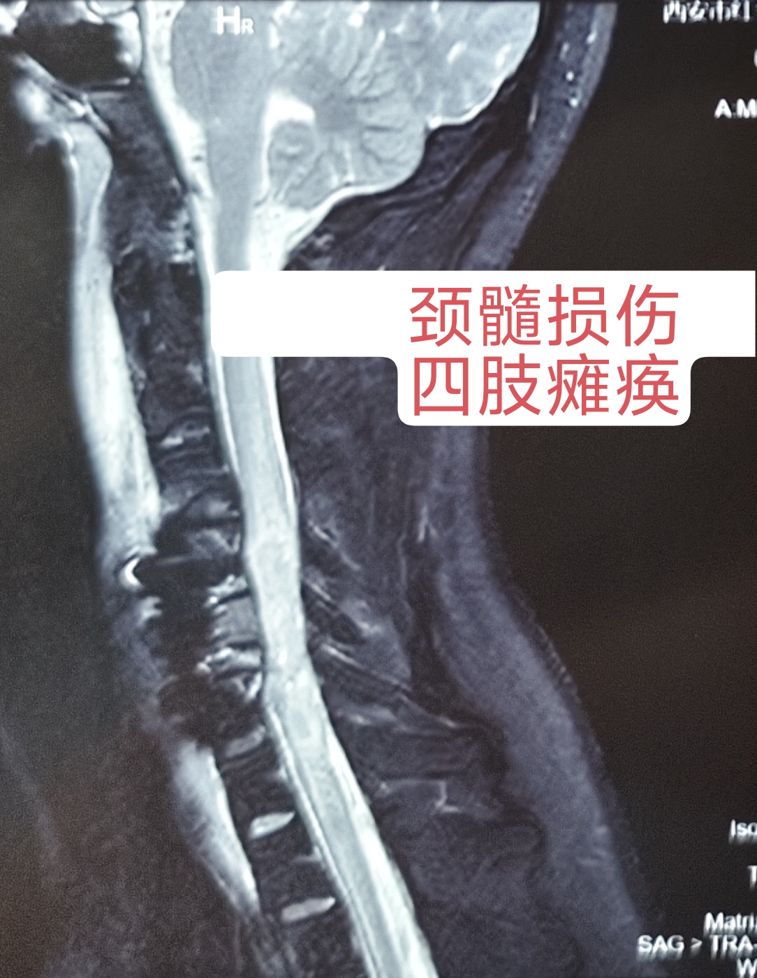 脊髓电刺激助力高位截瘫患者康复