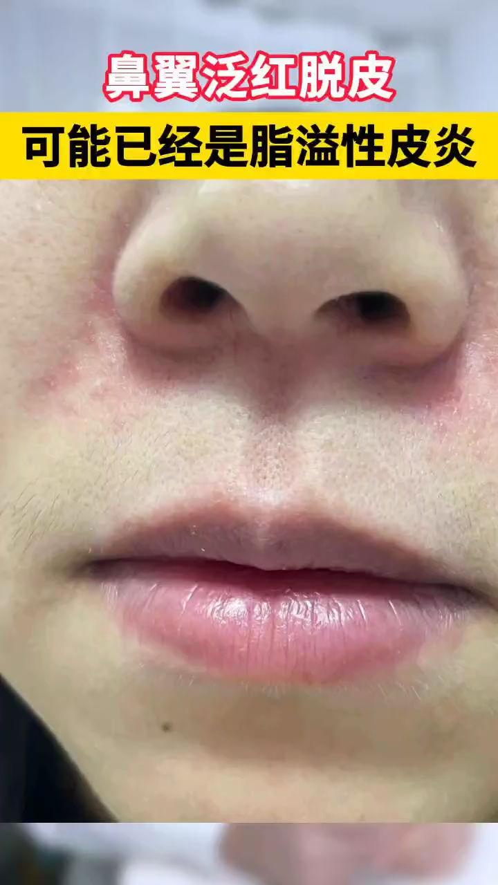 鼻子两边泛红发痒,还能抠出油腻的皮屑,得了脂溢性皮炎!