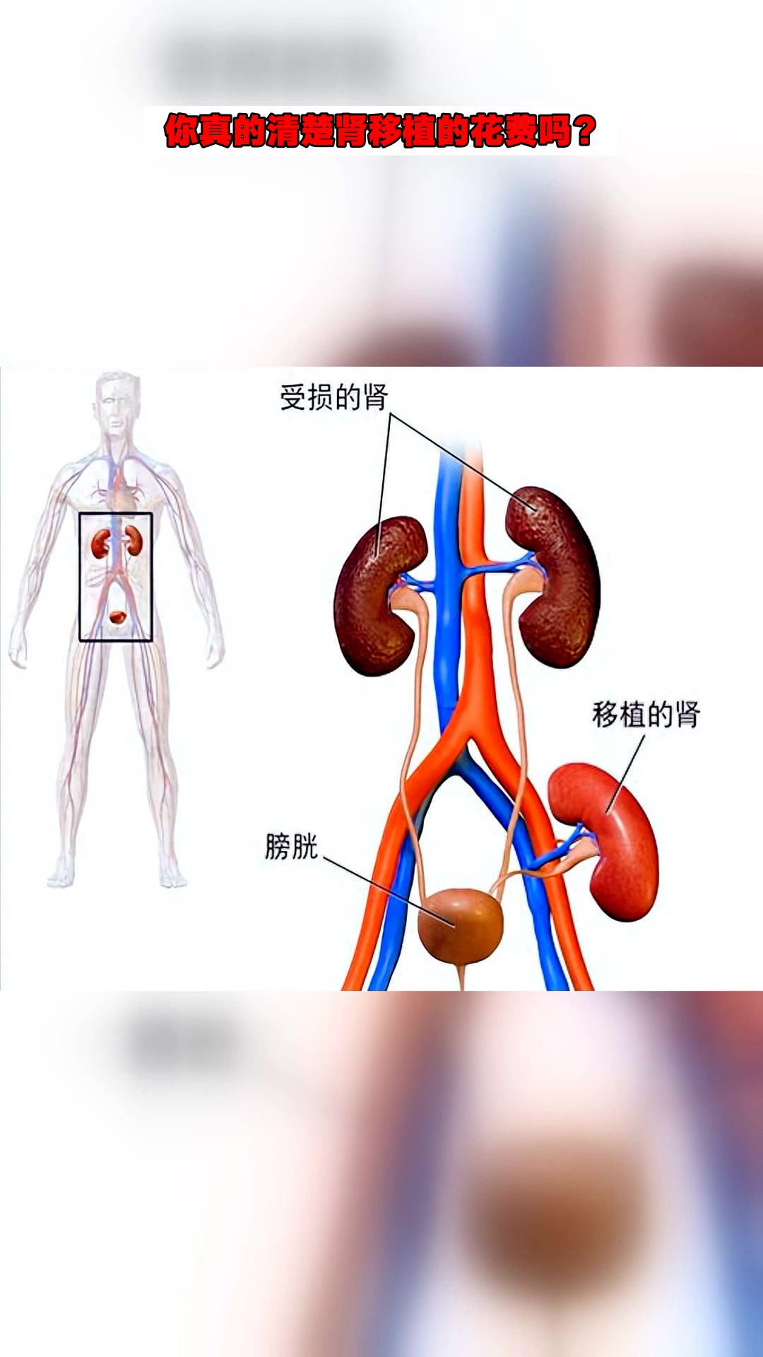 你真的清楚肾移植的花费吗?