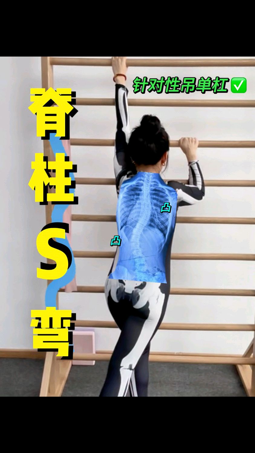 s型脊柱侧弯,如何更有针对性的吊单杠