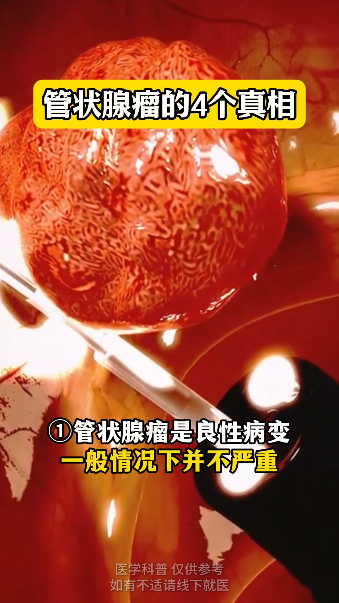 管状腺瘤的4个真相!