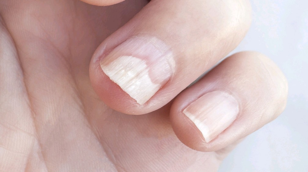 指甲上的白点,称为点状白甲症,最常见的原因是轻微外伤,比如指甲在