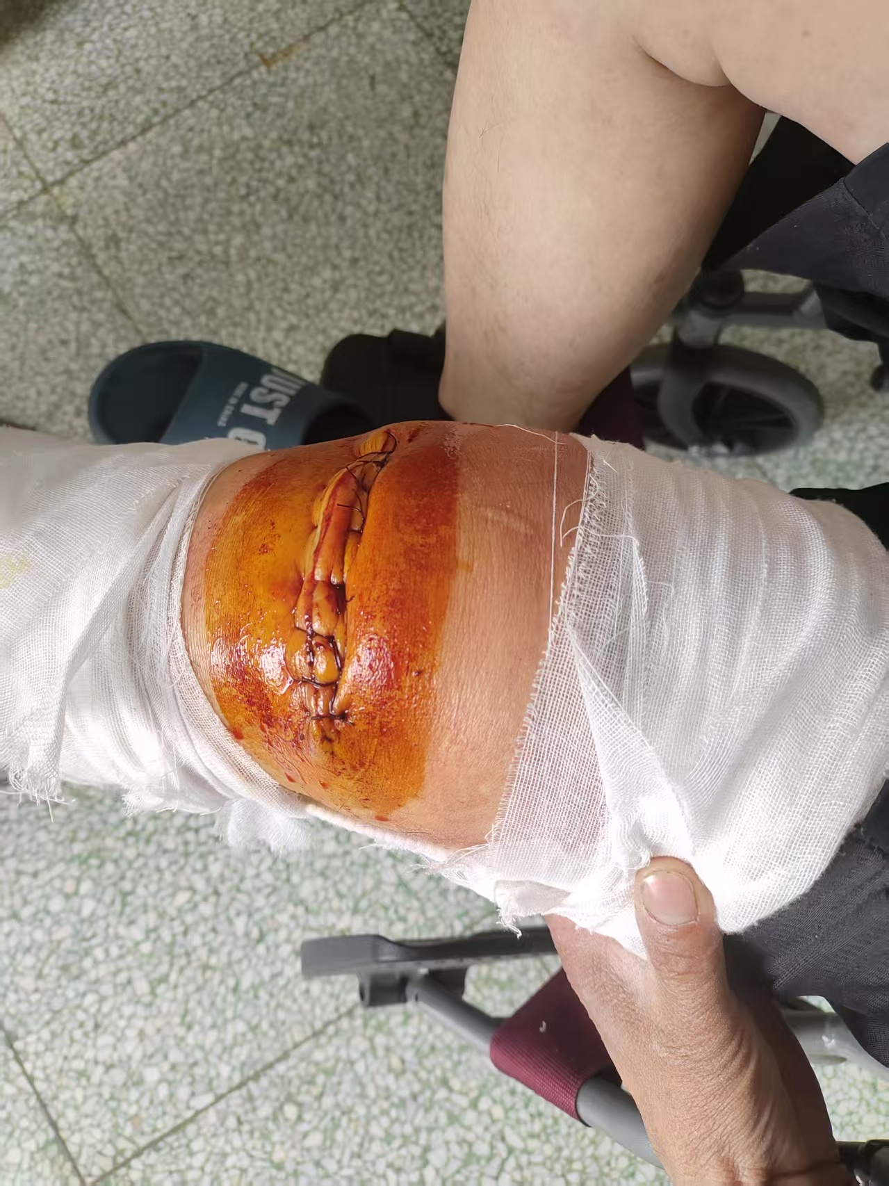 被机器给割伤的大腿,疼死了