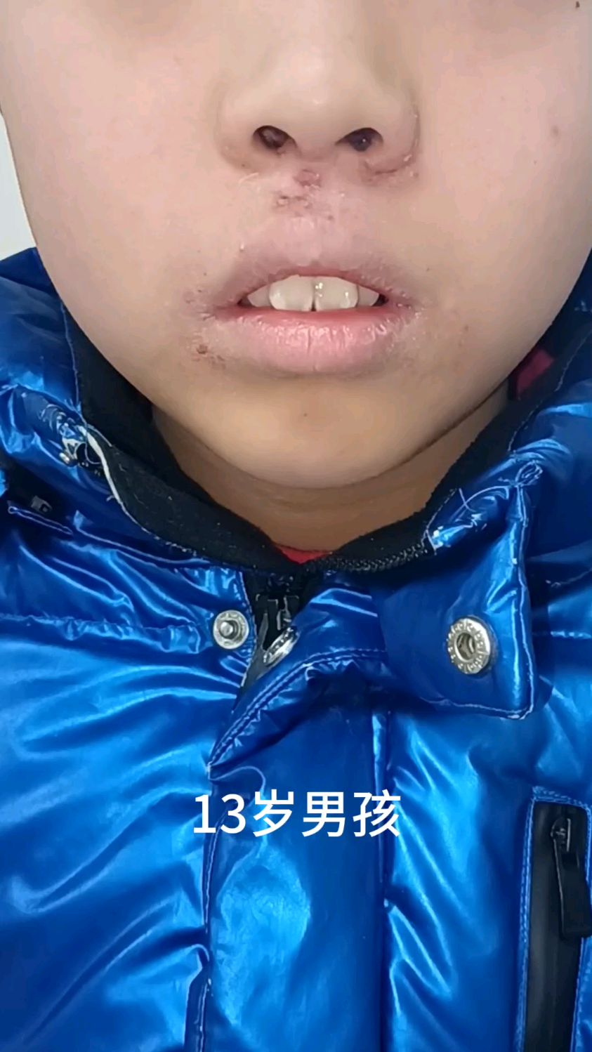 严重腺样体面容的孩子,即使手术,也回不到正常了