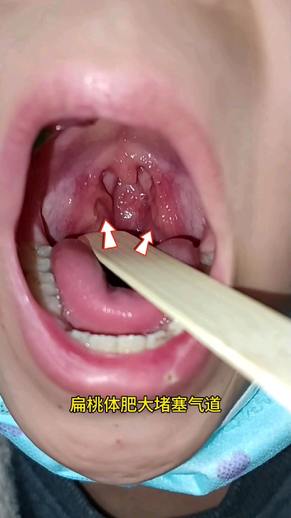 包埋型扁桃体,牙齿矫正的绊脚石,费时费力费孩子!