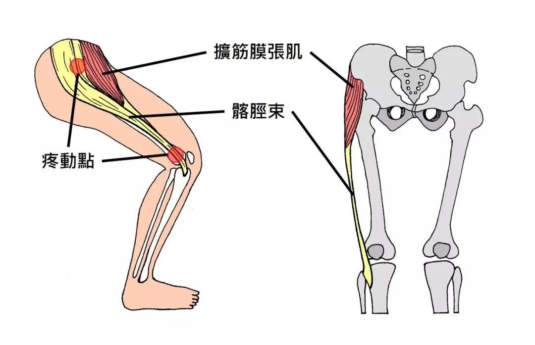髂胫束综合征:解码人体“隐形稳定带”的修复密码