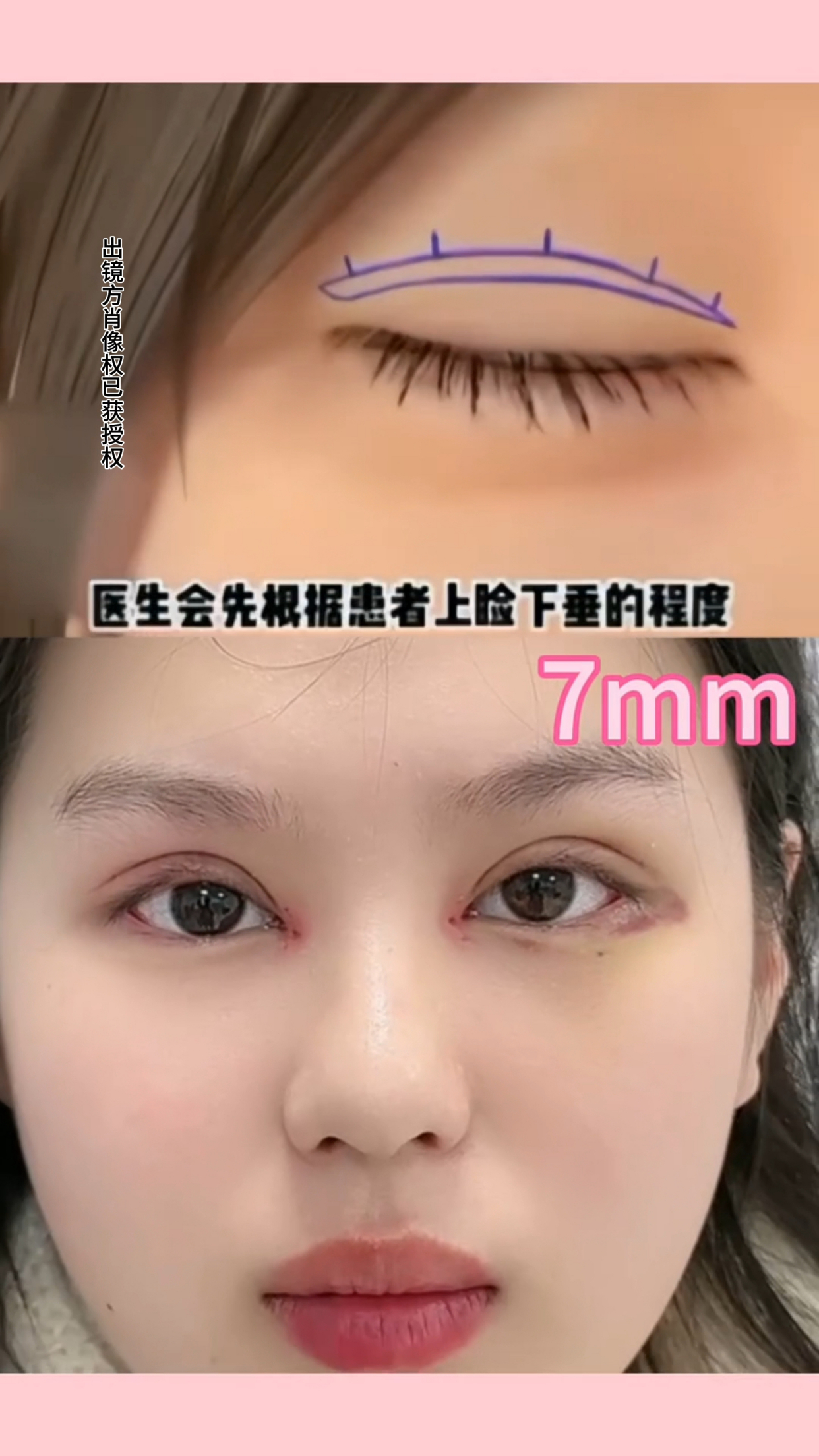 7mm双眼皮术后效果