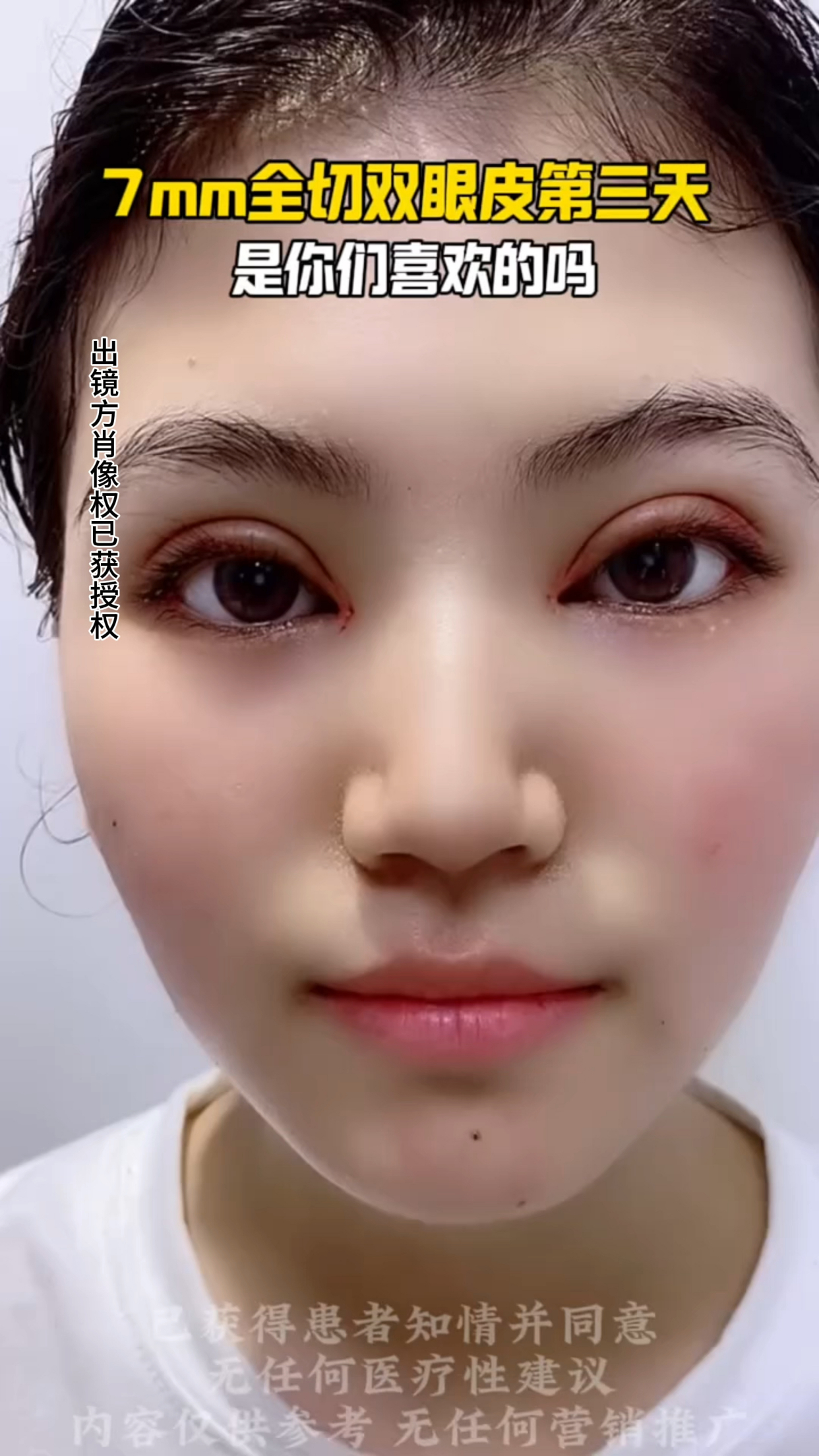 7mm全切双眼皮第二天