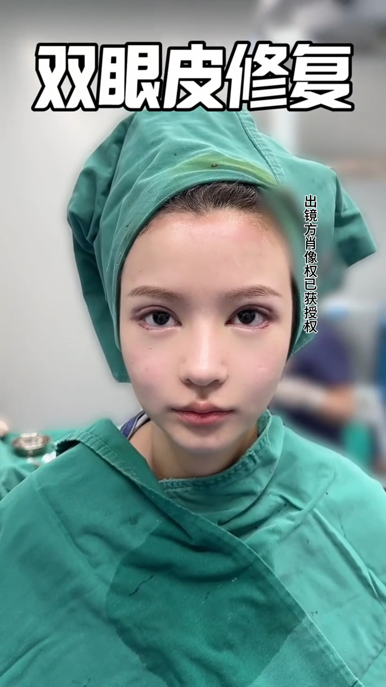 姑娘双眼皮修复术后