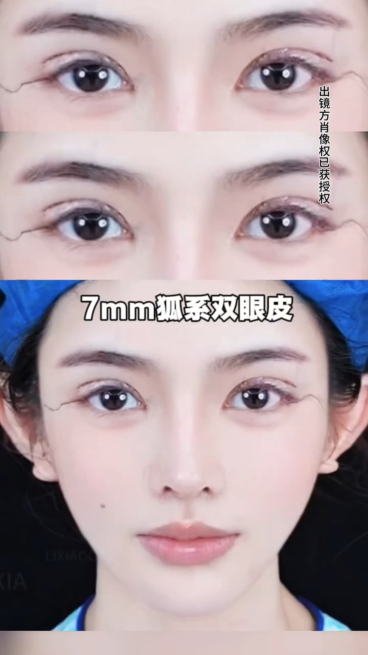 7mm狐系双眼皮效果