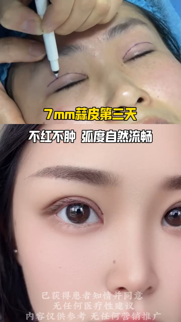 7mm双眼皮第三天