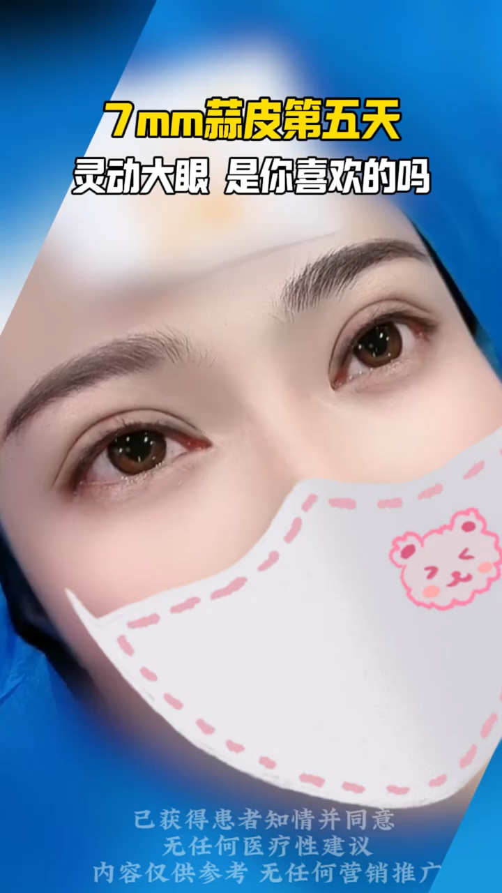 7mm双眼皮第五天,灵动大眼