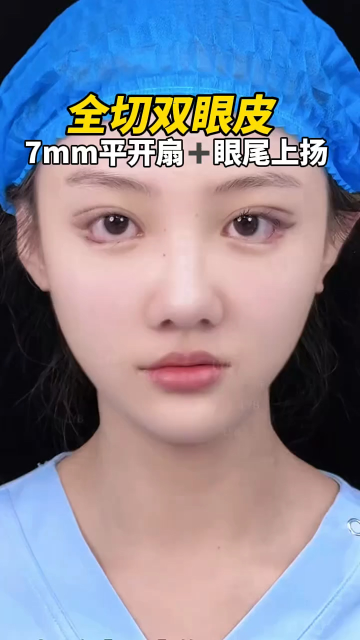 全切双眼皮7mm开扇效果