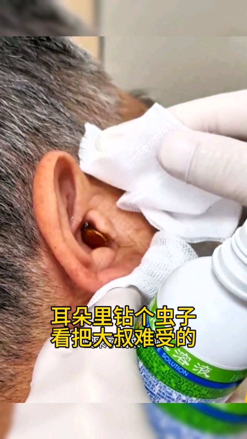 耳朵里钻个虫子,这可怎么办?