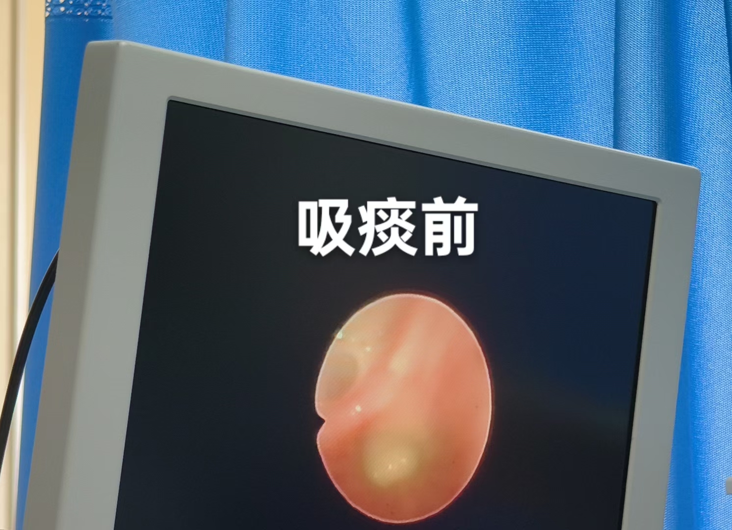 重症康复给患者进行支气管镜检查灌洗肺部深部痰液