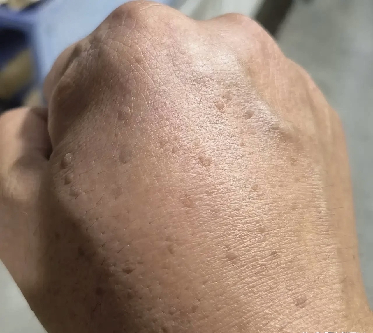 手背上不知何时就冒出了好多这种小点点.这是老人斑吗?