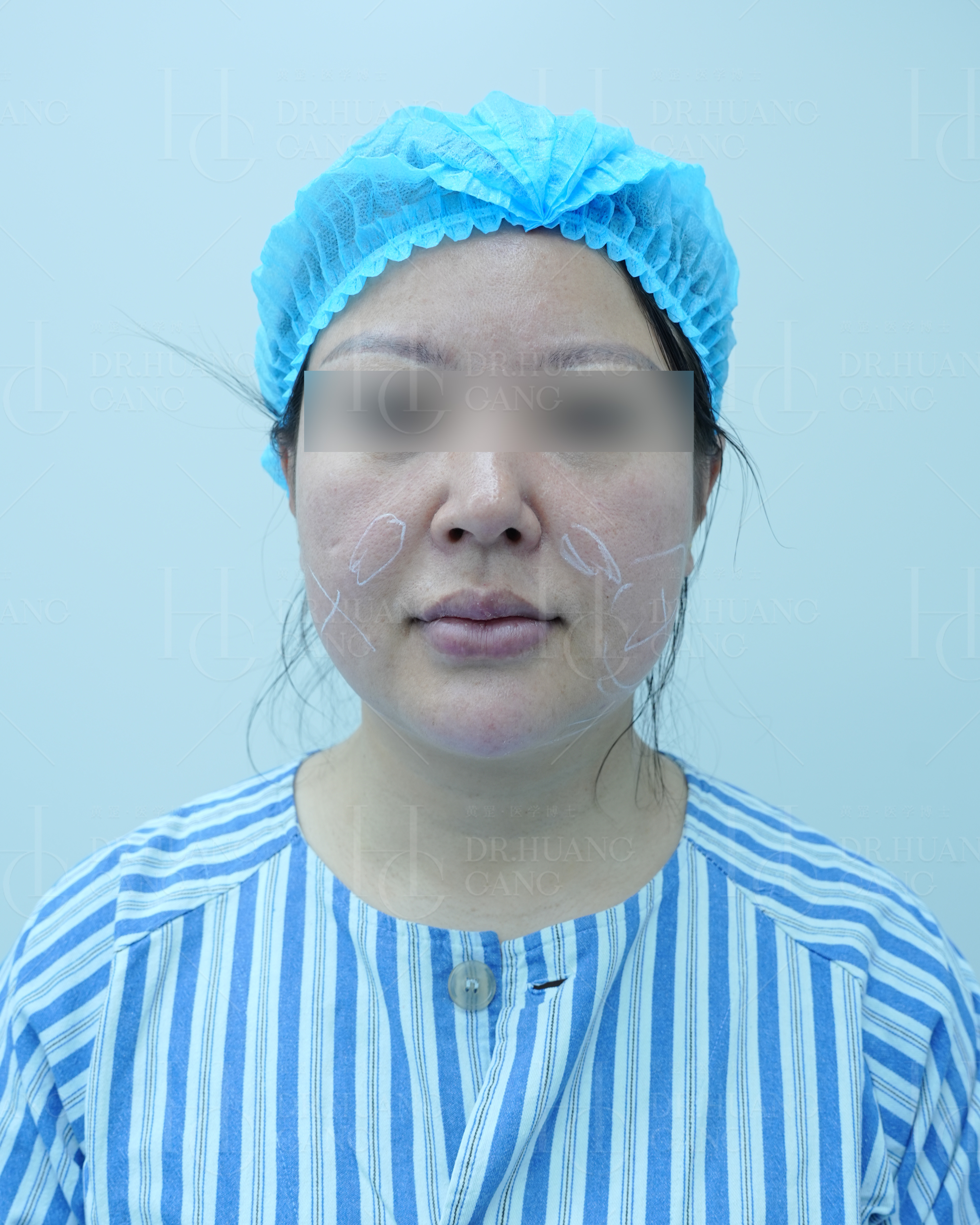 先来说说负压吸脂,吸脂界"元老"