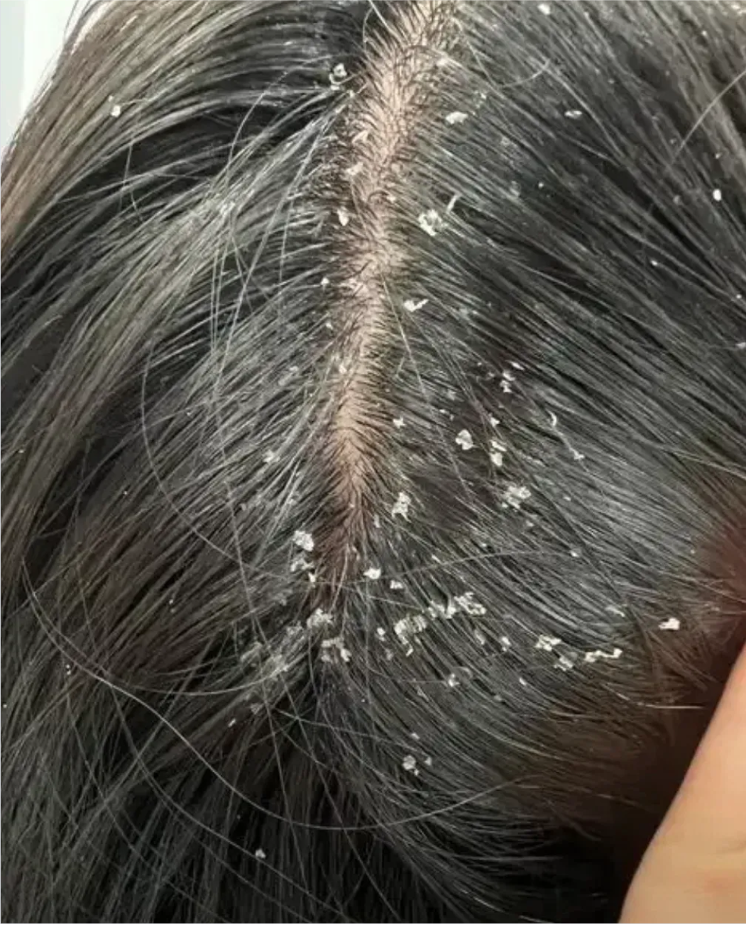 她被头屑狠狠折磨,头皮长满大块皮痂