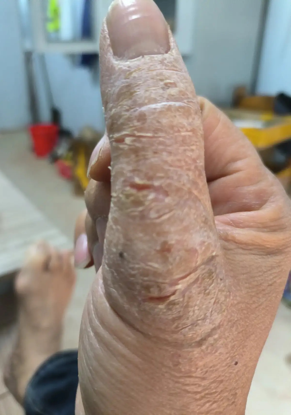 热点引擎计划#慢性湿疹慢性湿疹图片手指湿疹图片手部湿疹图片手指