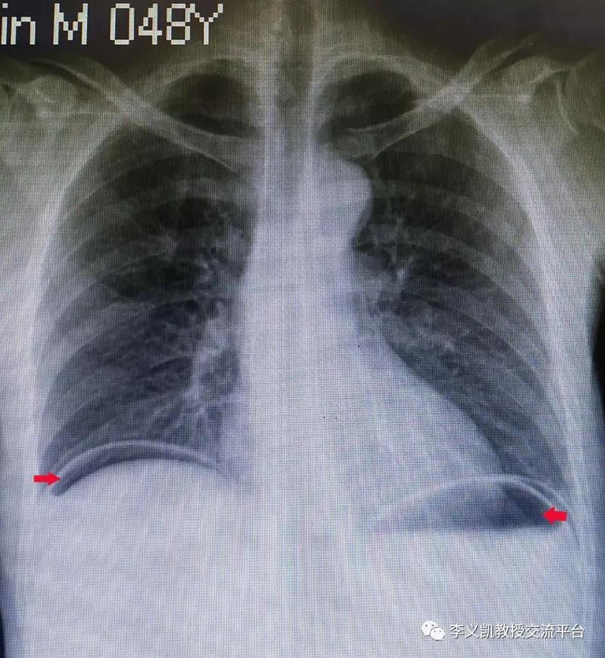 小心有胃肠穿孔 本例患者的双侧膈下均有气体,此征象多是胃肠穿孔所