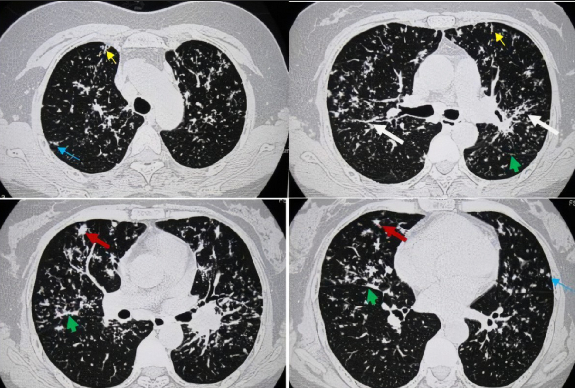 肺部ct,发现问题后,哪些是不需要药物治疗,你知道么?