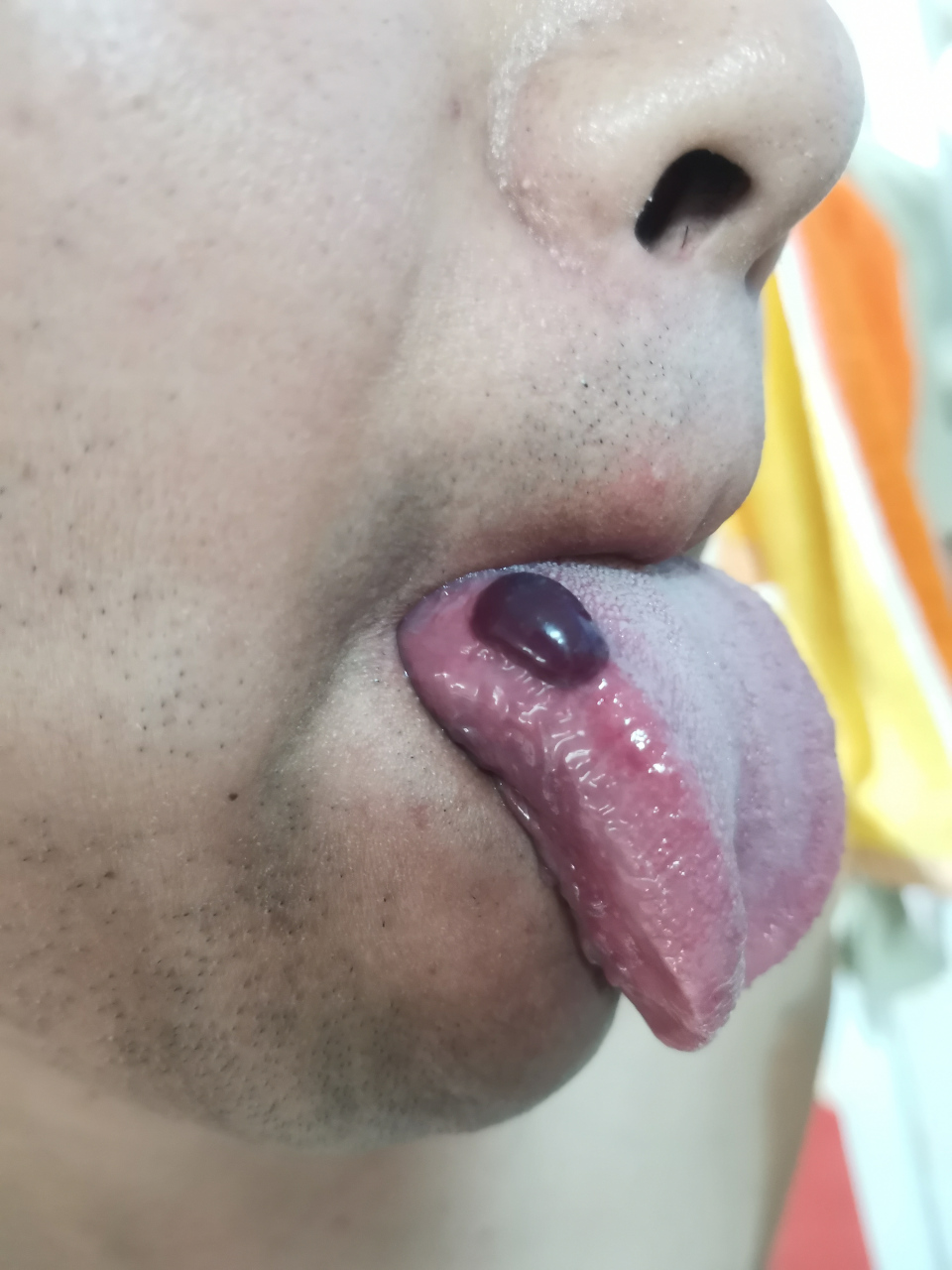 为什么正在吃饭的时候舌头上起了一个大血泡呢,怪膈应人的,有谁能告诉