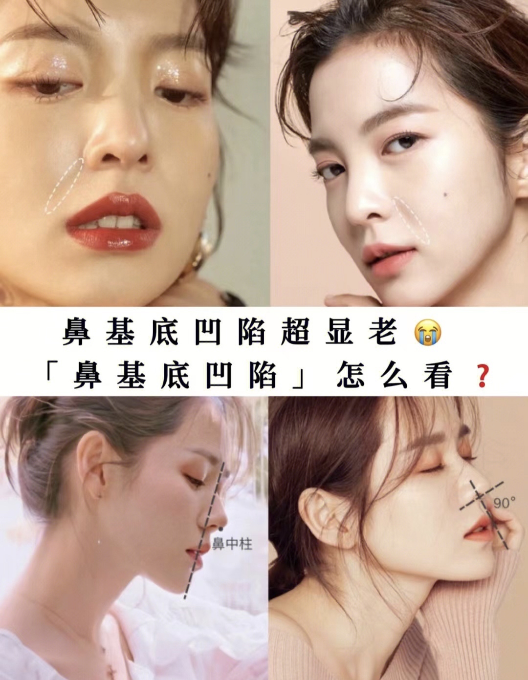 什么是鼻基底凹陷
